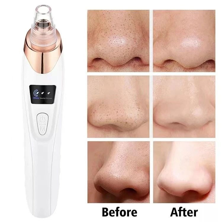 5-in-1 Acne & Blackhead Remover