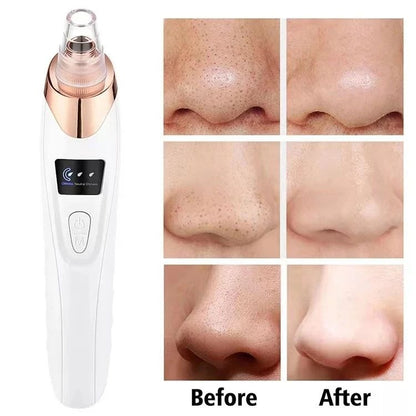 5-in-1 Acne & Blackhead Remover